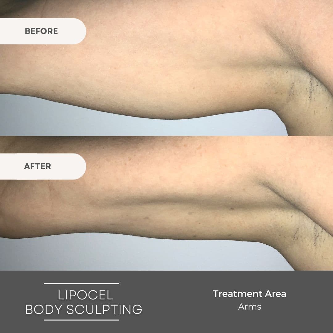 Elite Body Contouring Cronulla
