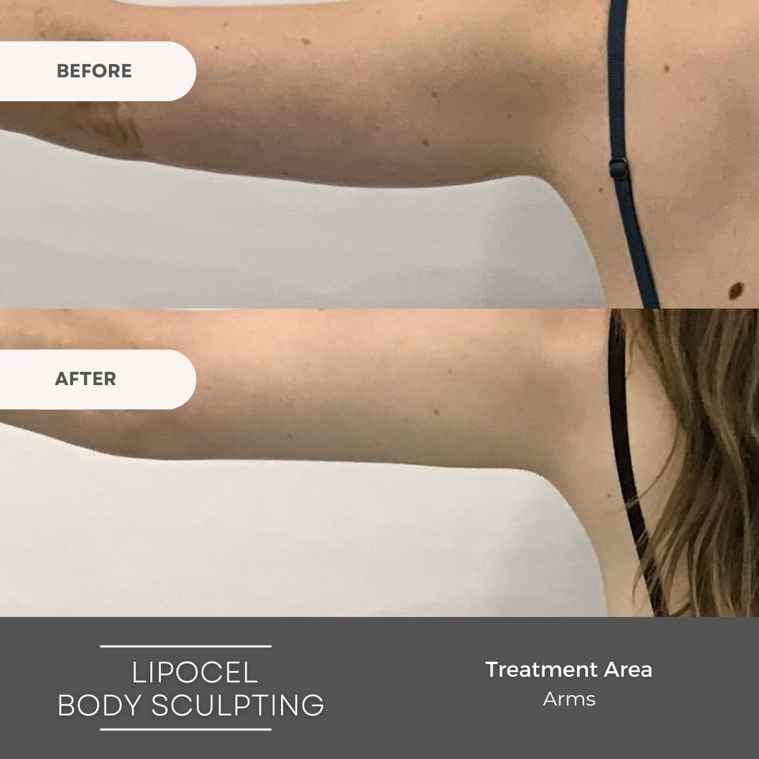 Elite Body Contouring Cronulla